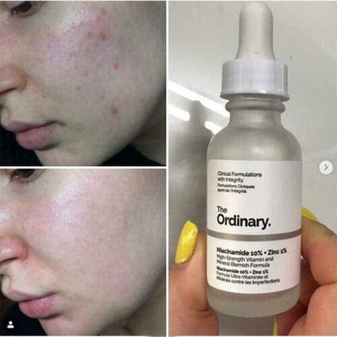 The Ordinary Niacinamide 10% + Zinc 1% Face Serum Original With Code